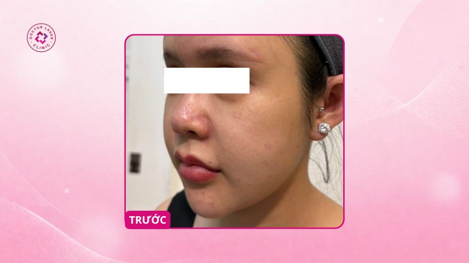 giãn mao mạch sau dùng corticoid trước điều trị