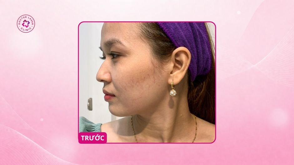 giãn mao mạch trên nền da mỏng trước điều trị