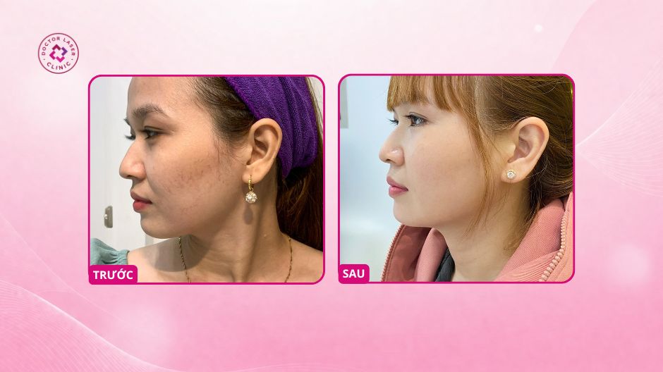 kết quả cải thiện giãn mao mạch sau điều trị