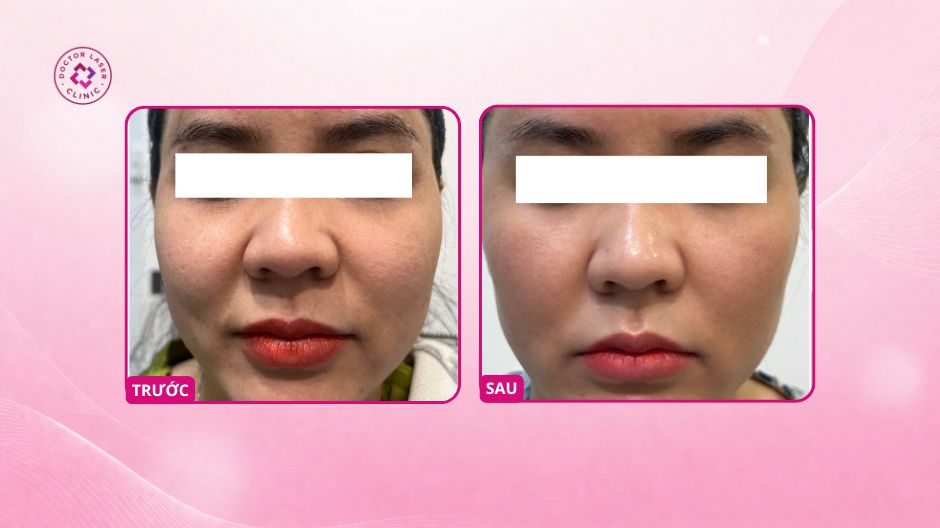 làn da sau liệu trình prp