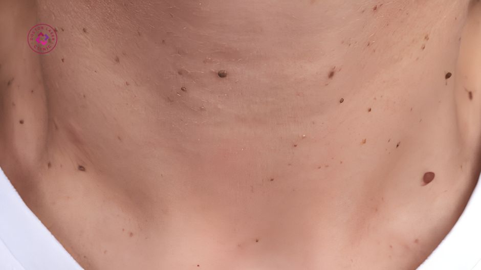 lão hóa da làm tăng nguy cơ mụn thịt