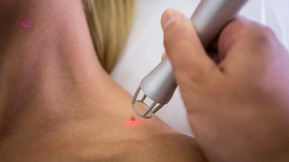 laser co2 điều trị mụn thịt
