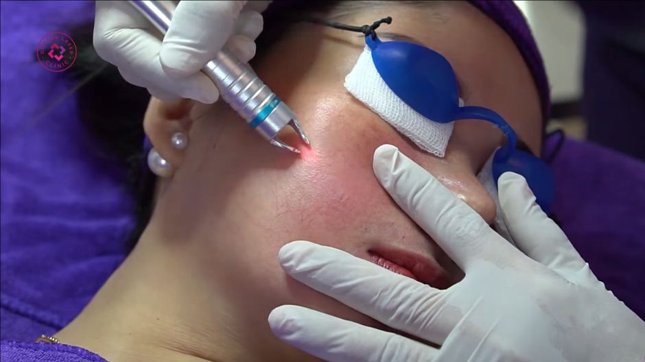 laser điều trị nám da bẩm sinh