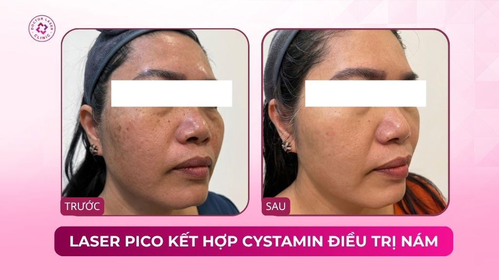 laser pico kết hợp cystamin điều trị nám lâu năm
