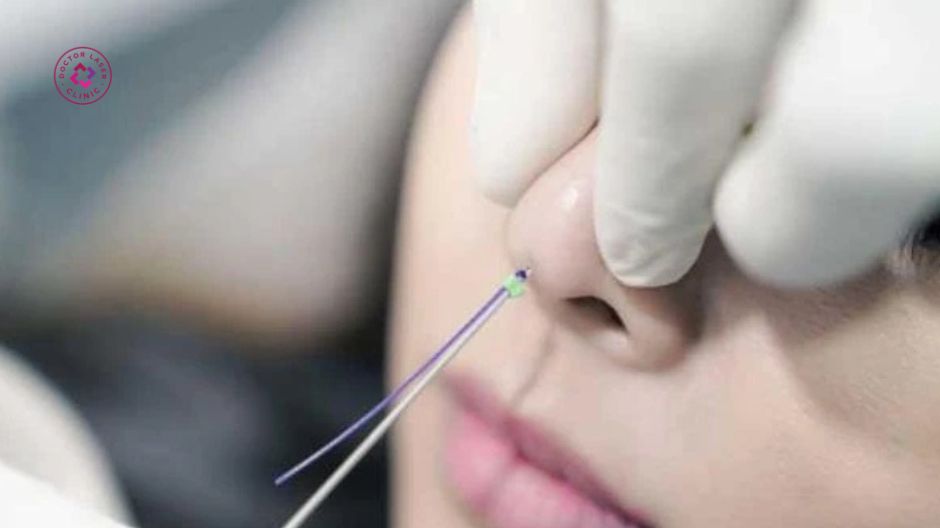 lưu ý khi nâng mũi bằng chỉ hoặc tiêm filler