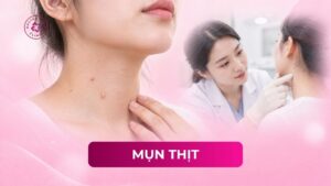 mụn thịt