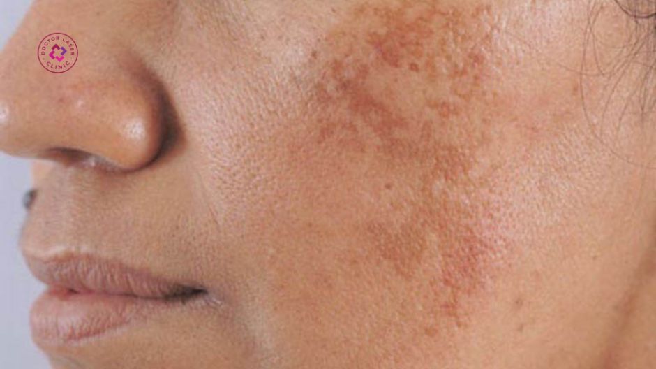 nám da là dạng tăng sắc tố da