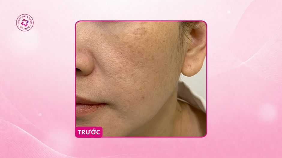 nám hai bên má trước điều trị