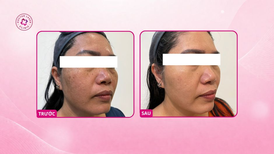nám lâu năm cải thiện sau 4 lần điều trị laser pico