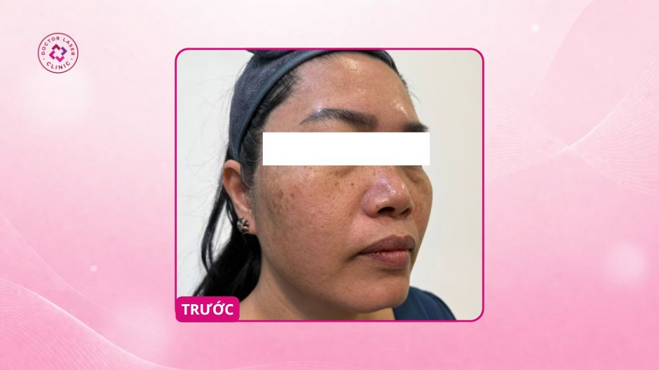 nám lâu năm trước điều trị laser pico