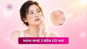 nám nhẹ 2 bên gò má