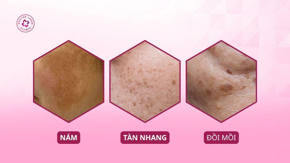 nám tàn nhang và đồi mồi có khác nhau không