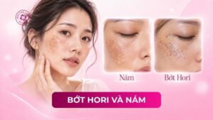 bớt hori và nám