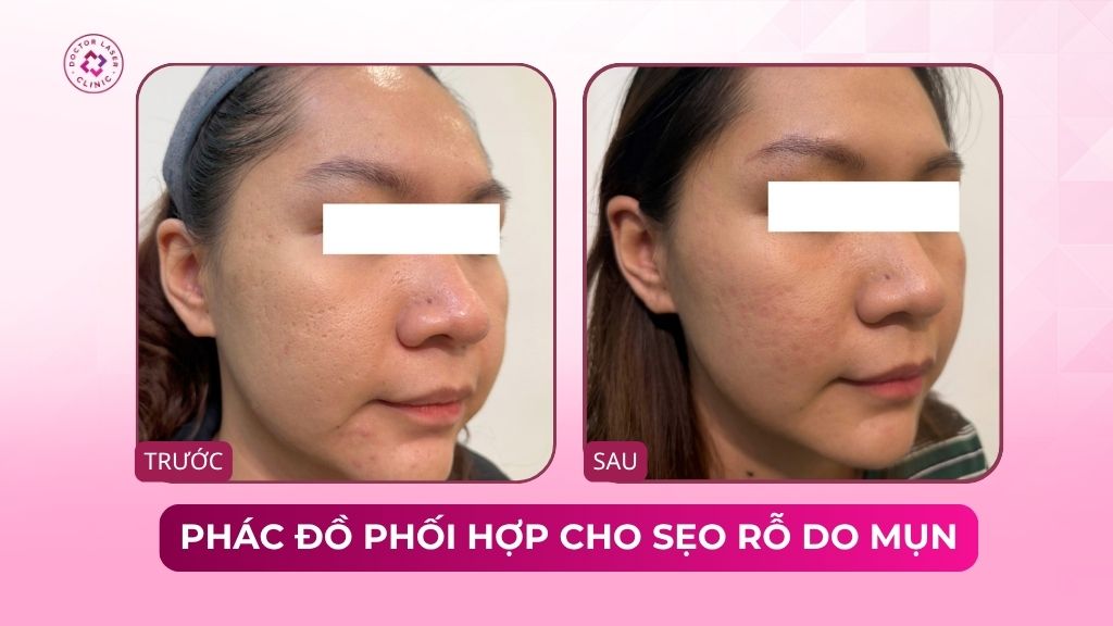 phác đồ phối hợp cho sẹo rỗ do mụn