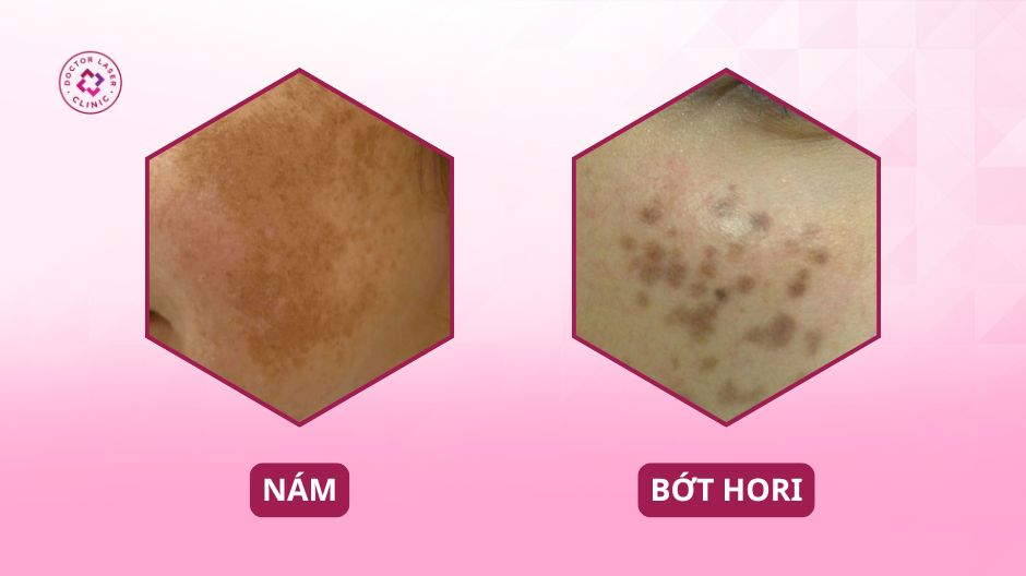 phân biệt bớt hori và nám da