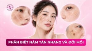 phân biệt nám tàn nhang và đồi mồi