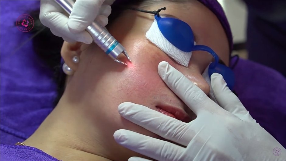 quy trình điều trị giãn mao mạch