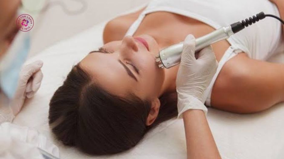 sóng vô tuyến cao tần rf điều trị giãn mao mạch ở mặt