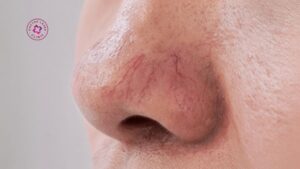 sau laser giãn mao mạch chăm sóc da thế nào