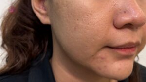 sẹo rỗ điều trị nhiều nơi không cải thiện