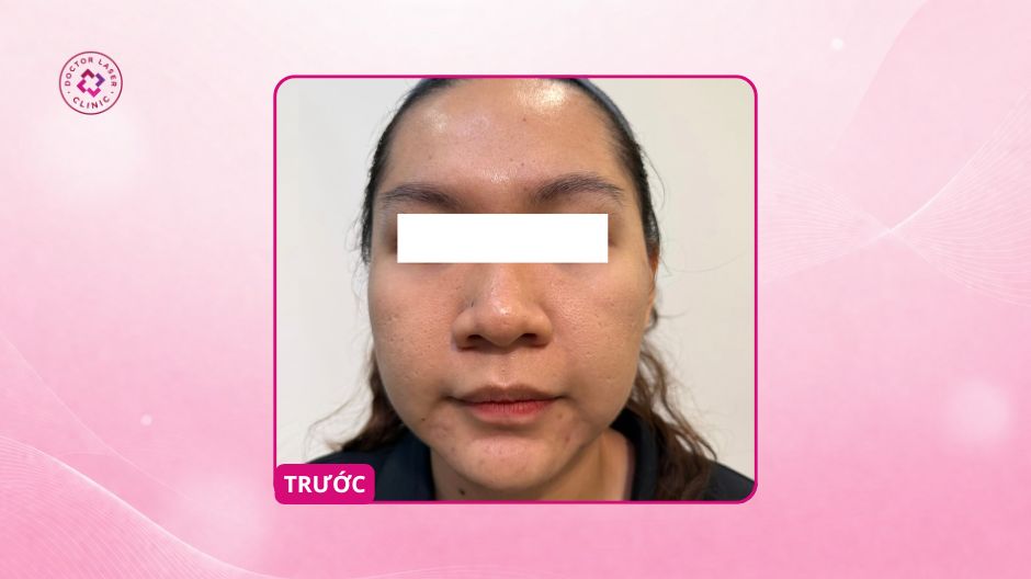 sẹo rỗ lâu năm trước điều trị