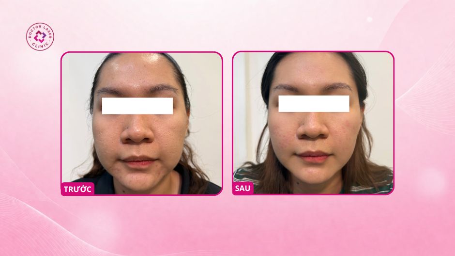 sẹo rỗ sau 2 buổi điều trị