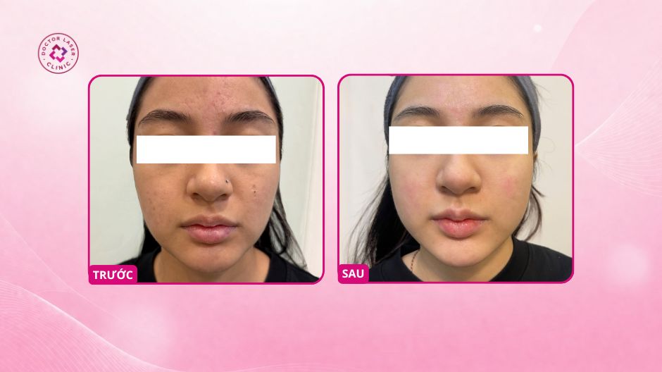 sẹo rỗ sau mụn cải thiện sau điều trị laser co2 fractional