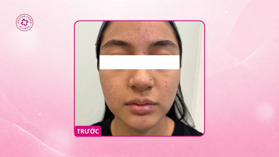 sẹo rỗ sau mụn trước điều trị laser co2 fractional