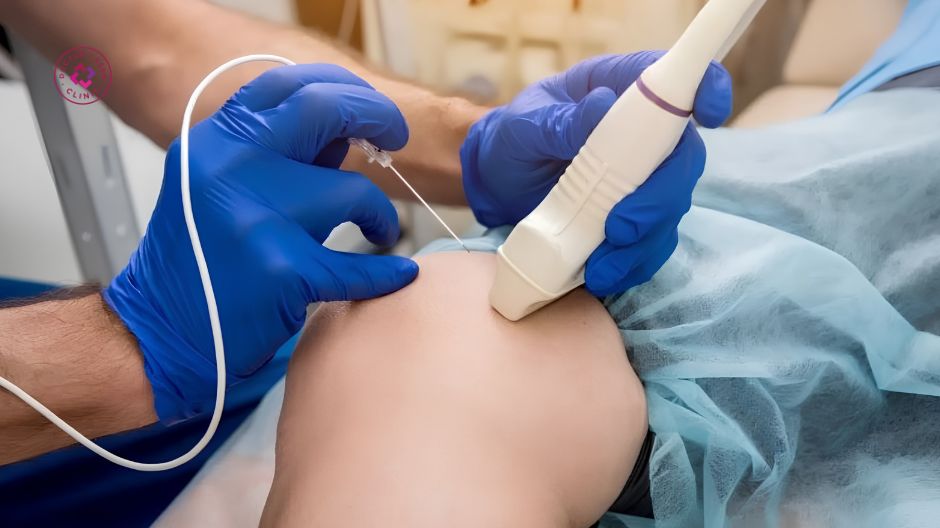 sóng cao tần rf điều trị giãn mao mạch ở chân