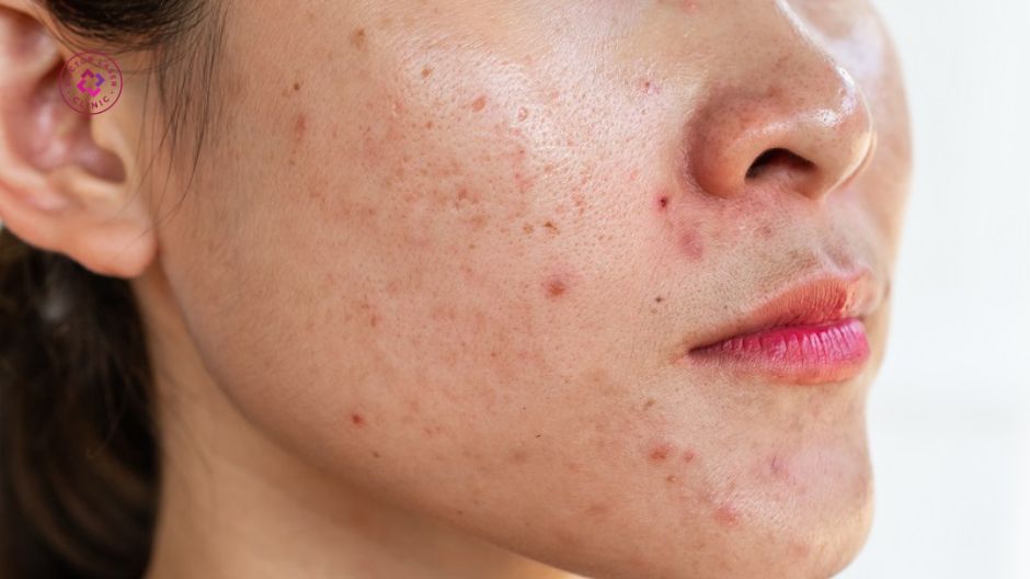 sữa rửa mặt cho da dầu nhiều mụn ẩn và bít tắc