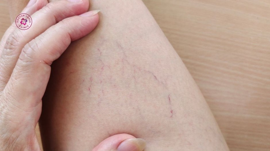 suy giãn tĩnh mạch mãn tính và giãn mao mạch