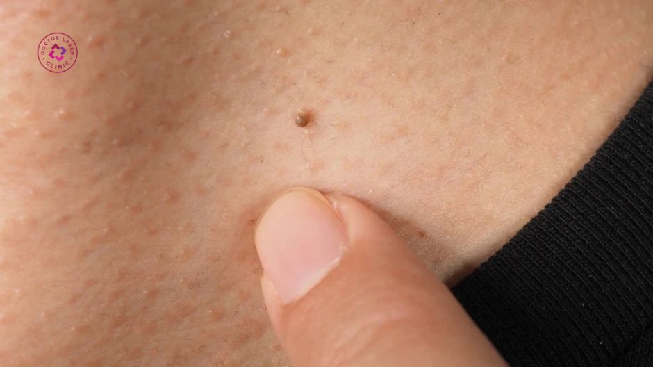 tắc tuyến mồ hôi và mụn thịt