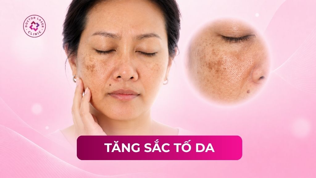 Tăng sắc tố da: Nguyên nhân, dấu hiệu và cách điều trị