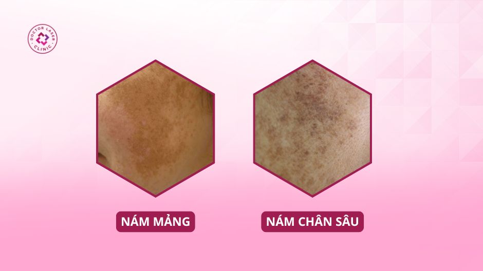 cách phân biệt nám mảng và nám chân sâu