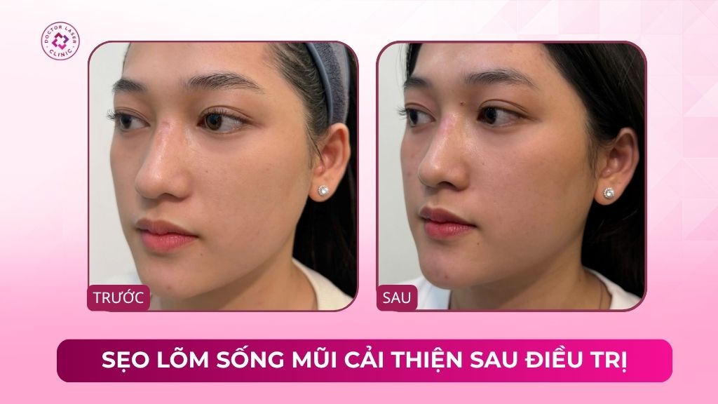 cải thiện sẹo lõm sống mũi bằng tách đáy sẹo và laser co2