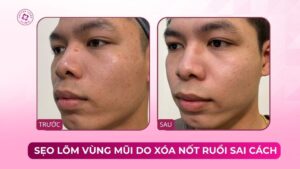 cải thiện sẹo lõm vùng mũi do xóa nốt ruồi sai cách