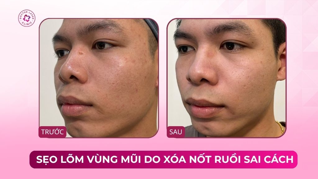 cải thiện sẹo lõm vùng mũi do xóa nốt ruồi sai cách