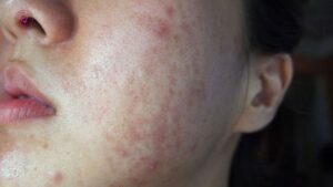 da mỏng yếu do kem trộn có trị sẹo rỗ được không