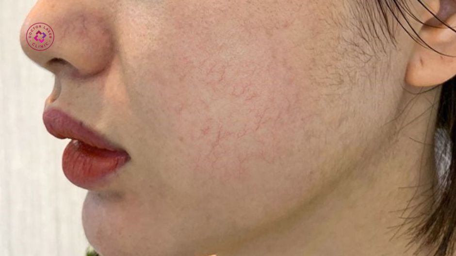 ấu hiệu giãn mao mạch ở mặt