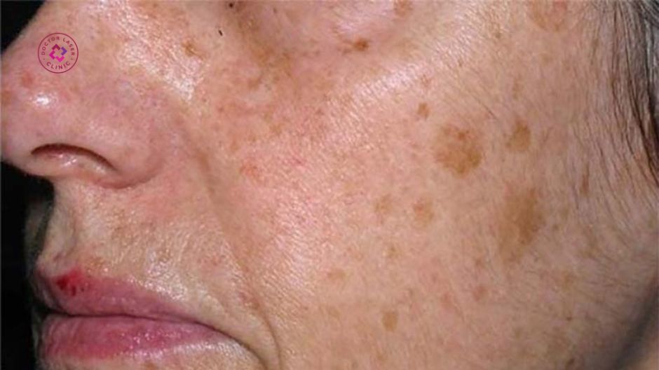 dấu hiệu nhận biết đồi mồi trên da