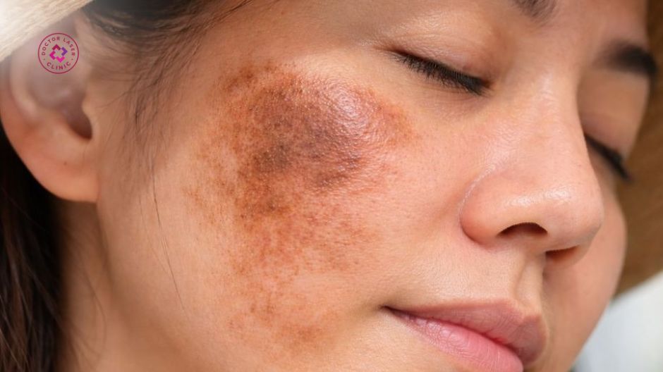 dấu hiệu nhận biết tăng sắc tố sau peel