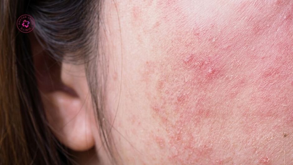 dấu hiệu nhận biết tăng sắc tố sau viêm