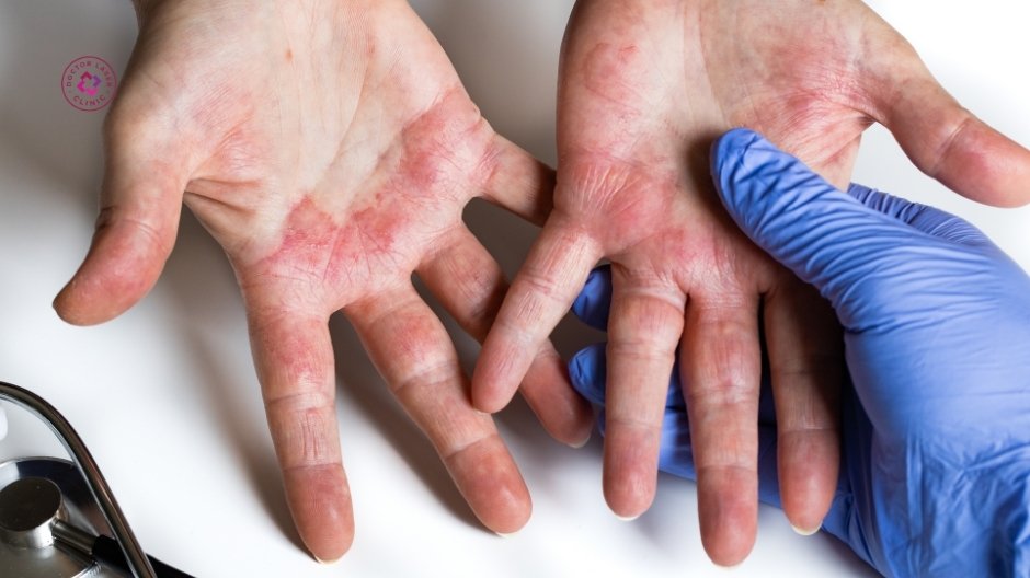 điều trị sớm bệnh viêm da hạn chế giảm sắc tố