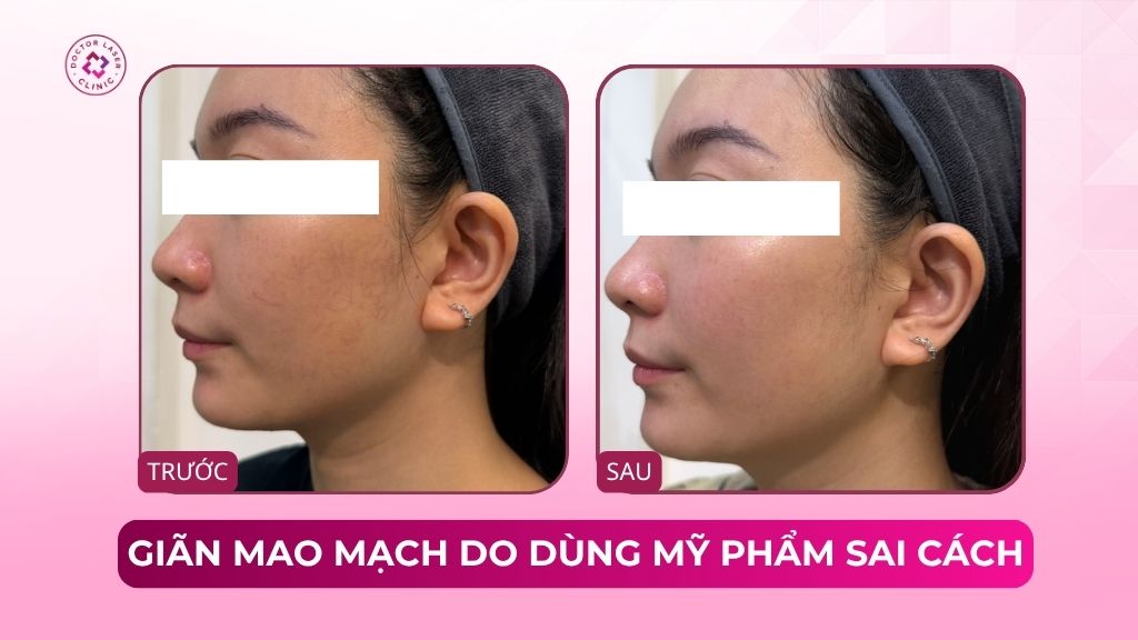 giãn mao mạch do sử dụng mỹ phẩm sai cách