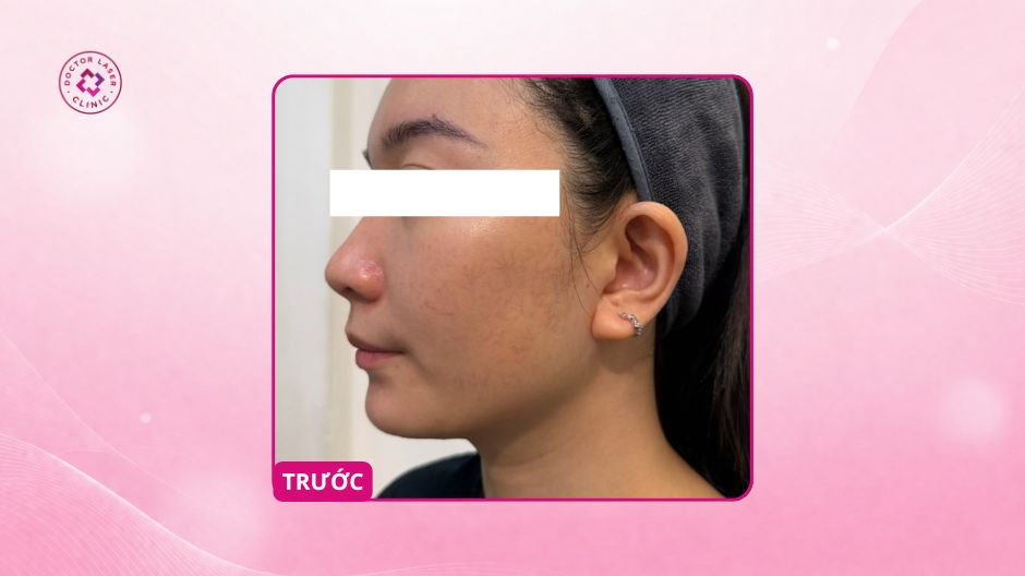 giãn mao mạch má cánh mũi trước điều trị