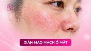 giãn mao mạch ở mặt