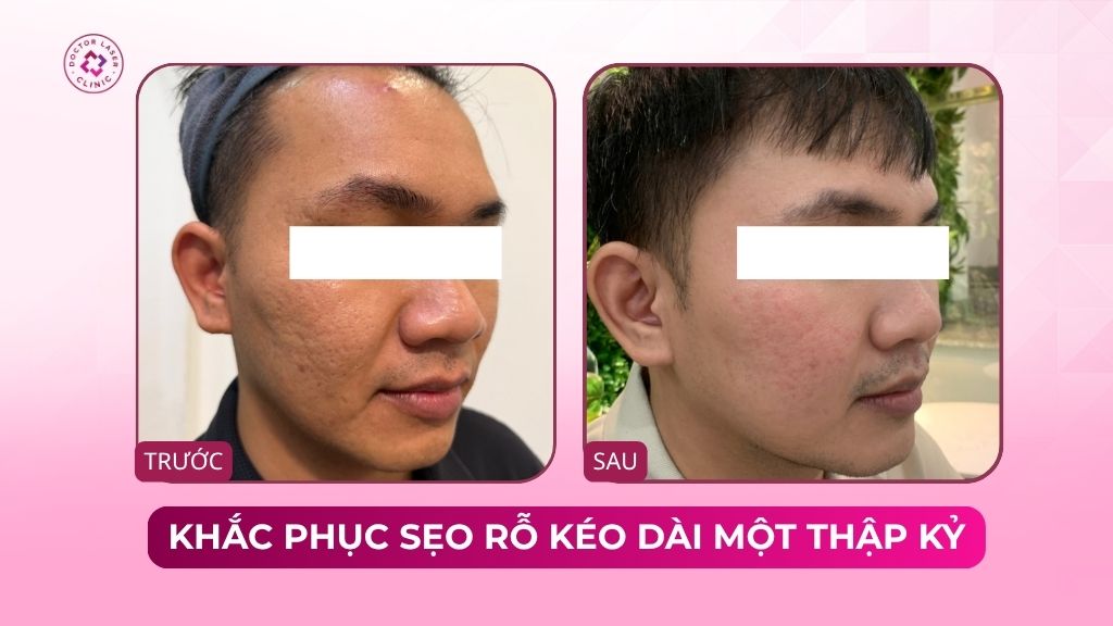 hành trình khắc phục sẹo rỗ kéo dài một thập kỷ