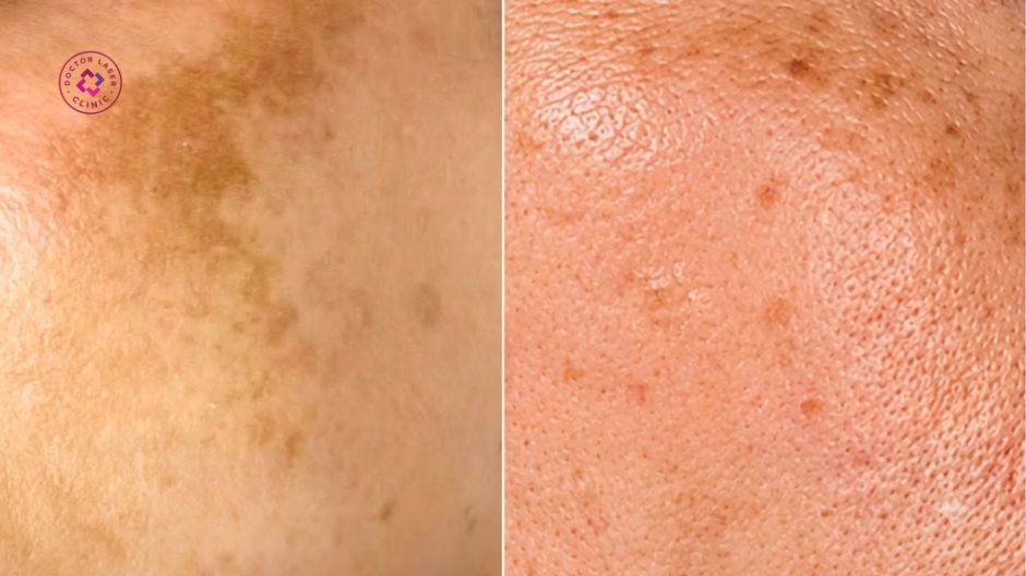 hướng dẫn cách phân biệt nám và tăng sắc tố