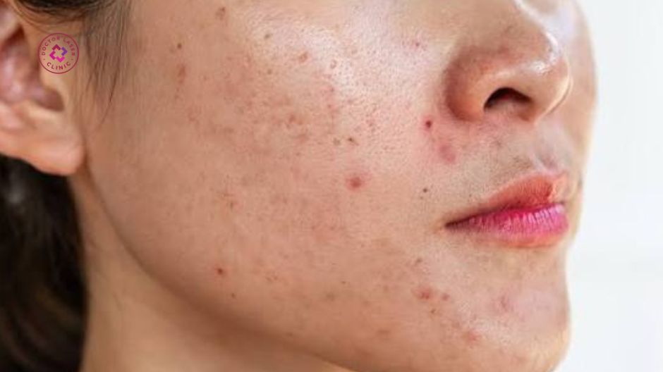 kem trị thâm mụn cho da nhạy cảm