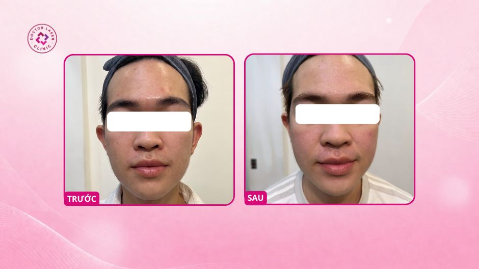 kết quả cải thiện sẹo rỗ hai bên má và trán sau 3 buổi laser co2 fractional